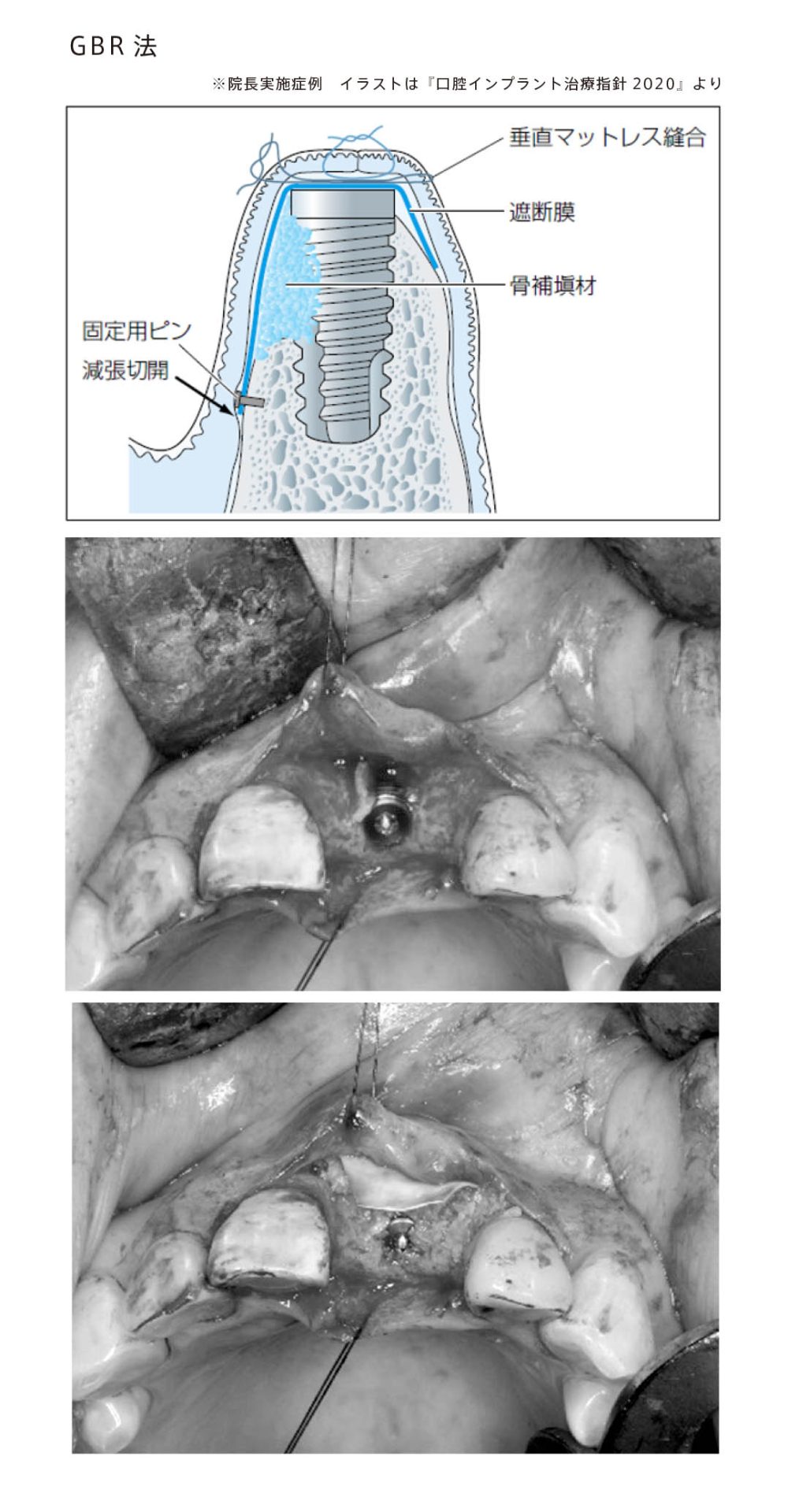 骨造成・骨移植 - 新潟市中央区 | インプラントと親知らず抜歯のかつみ 