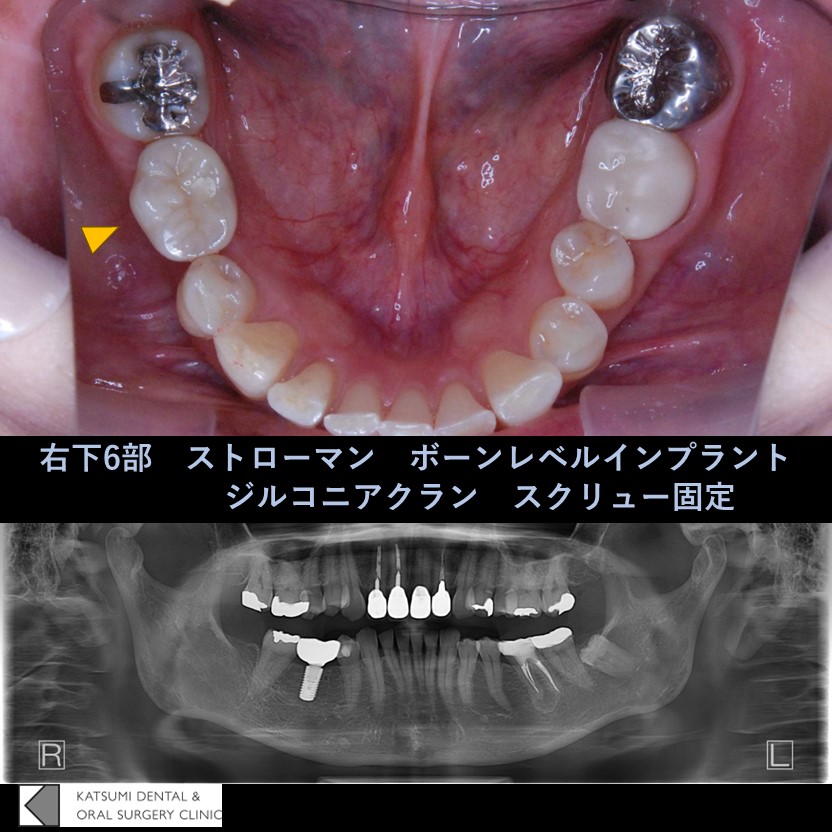 インプラント症例報告 - 新潟市中央区 | インプラントと親知らず