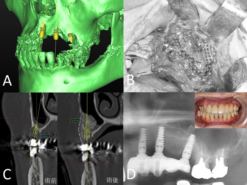 高度歯槽骨吸収症例