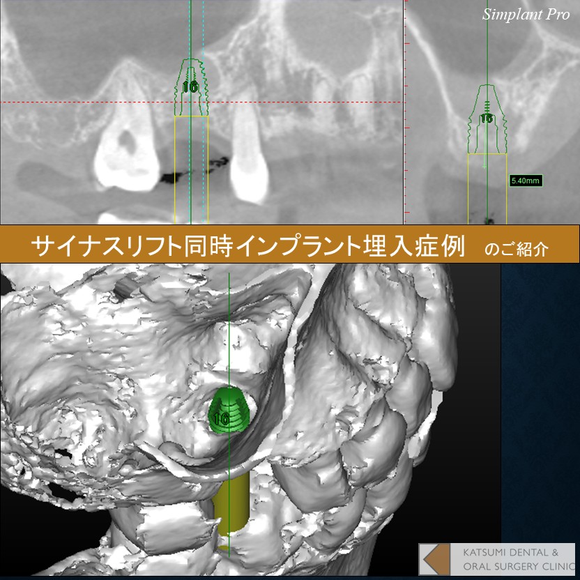 インプラント症例報告vol.13 サイナスリフト同時インプラント埋入