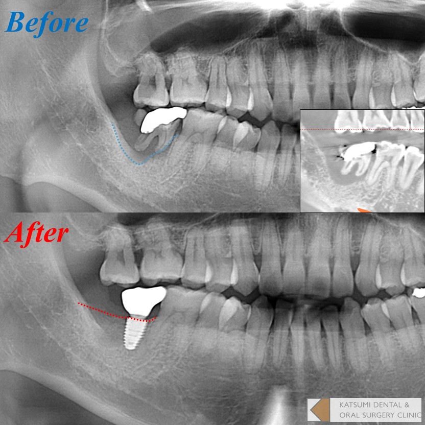 抜歯と同時に骨を再生する「歯槽堤温存術」（下顎編）について - 新潟